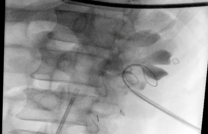 Litiasis rayos